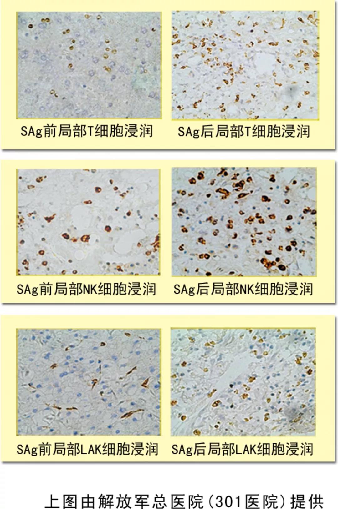NK细胞，抗癌的第一道防线